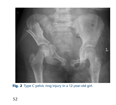 Frattura pediatrica di una dodicenne nel testo medico
